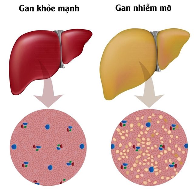 7 loại trái cây người bệnh gan nhiễm mỡ nên ăn để đẩy lùi các triệu chứng bệnh - Ảnh 3. 7 loại trái cây người bệnh gan nhiễm mỡ nên ăn để đẩy lùi các triệu chứng bệnh - Ảnh 3.