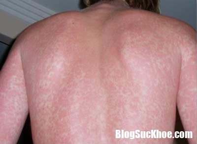 Những sự hiểu nhầm “chết người” về bệnh sốt xuất huyết dau hieu benh sot xuat huyet Những sự hiểu nhầm “chết người” về bệnh sốt xuất huyết